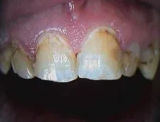 Decayed and Unsightly Teeth