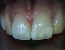Stained and Discolored teeth